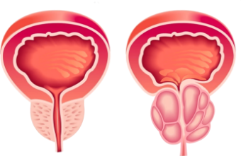 Dr Rodrigo Trivilato Urologista Goiania Goias Hiperplasia Prostatica